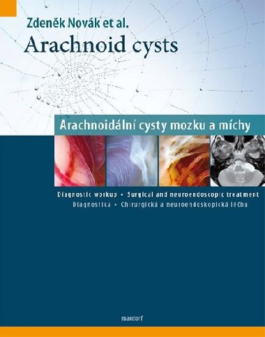 Arachnoid cysts - Arachnoidln cysty mozku a mchy - Zdenk Novk