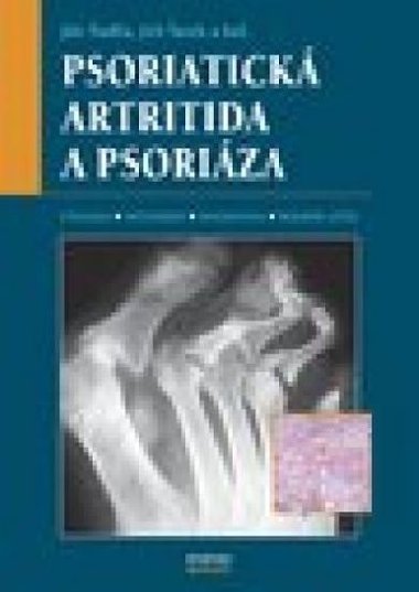 Psoriatick artritida a psoriza - tolfa Ji, tork Ji,