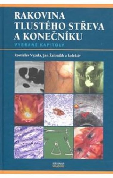 RAKOVINA TLUSTÉHO STŘEVA A KONEČNÍKU - Rostislav Vyzula; Jan Žaloudík