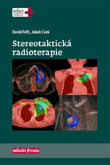 Stereotaktická radioterapie - David Feltl; Jakub Cvek