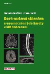 Roztrouen sklerza a onemocnn bl hmoty v MR zobrazen - Manuela Vankov; Zdenk Seidl
