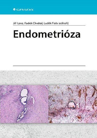 Endometriza - Lenz Ji; Chvtal Radek; Ludk Fiala
