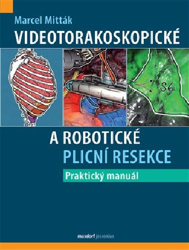 Videotorakoskopick a robotick plicn resekce - Marcel Mittk